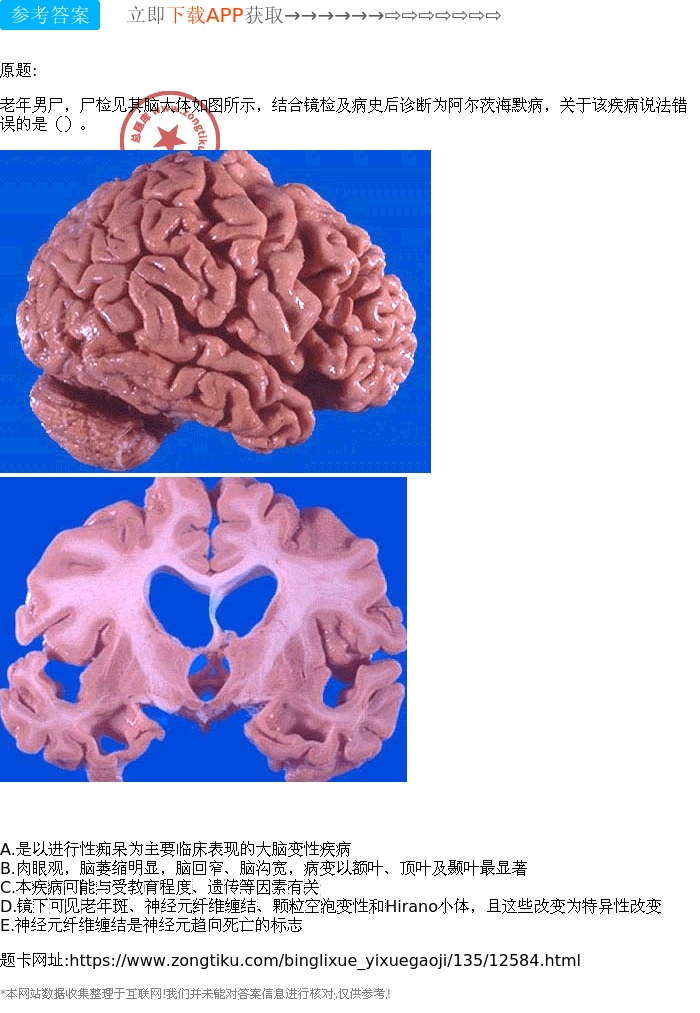 老年男尸,尸检见其脑大体如图所示,结合镜检及病史后诊断为阿尔茨海默