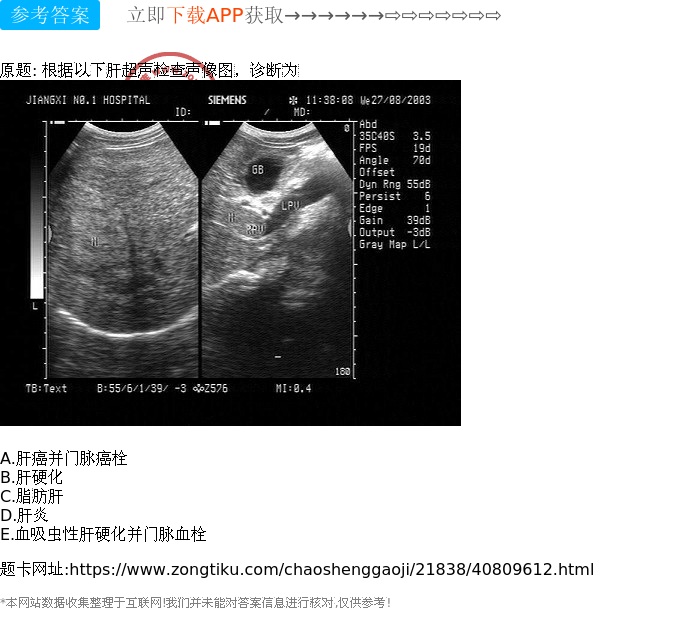 脂肪肝 d.肝炎 e.血吸虫性肝硬化并门脉血栓