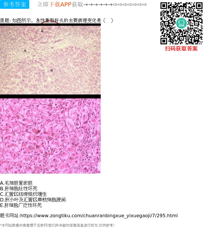 所有题库 传染病学(医学高级) 病毒性肝炎 题目详情