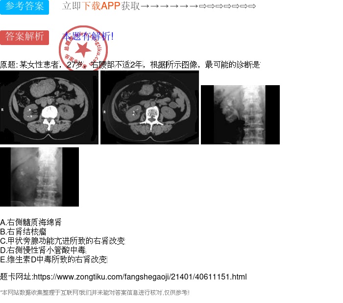 右侧髓质海绵肾 b.右肾结核瘤 c.甲状旁腺功能亢进所致的右肾改变 d.