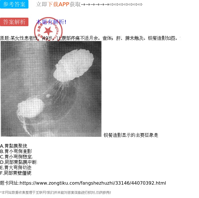 胃小弯侧憩室 d.局部胃黏膜中断 e.胃大弯侧切迹 f.局部胃壁僵硬