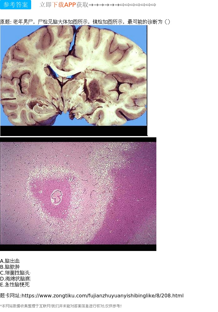 脑出血 b.脑脓肿 c.细菌性脑炎 d.海绵状脑病 e.急性脑梗死