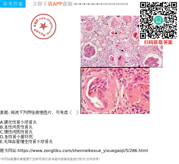 慢性间质性肾炎 d.急性肾小管坏死 e.毛细血管增生性肾小球肾炎