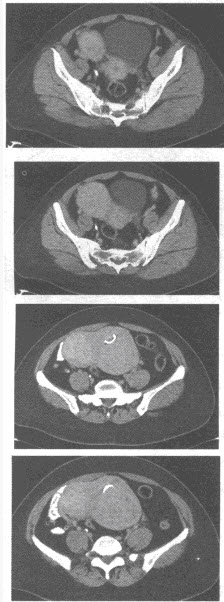 女,35岁,下腹部不适,ct扫描子宫增大呈分叶状,ct扫描如图所示,首先