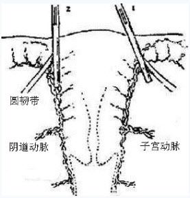 经腹全子宫切除术的术前准备不妥当是()