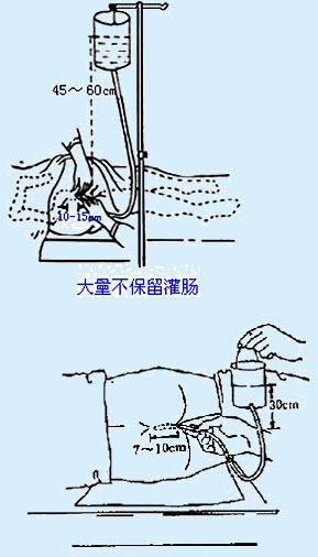 大量不保留灌肠与小量不保留灌肠的区别是()