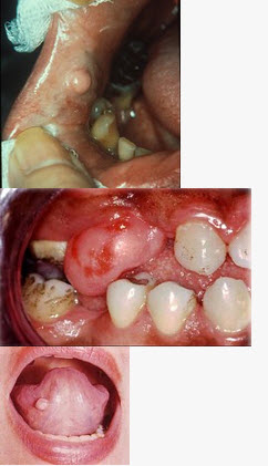 组图为口内纤维瘤的外观,关于此病的描述不正确的是()