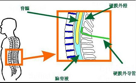 如图所示,硬膜外需留置导管一般主张以哪一时间为限()