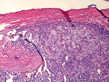 如图为甲状腺腺瘤镜下观和甲状腺高分化滤泡癌镜下观,仔细比较,二者最