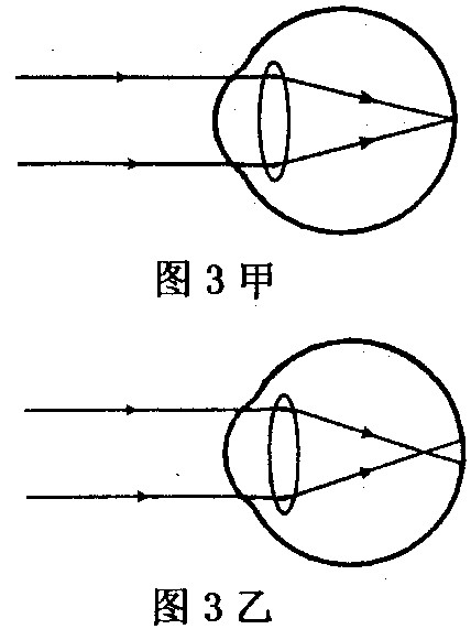 a:她患的是近视眼,应配戴凸透镜矫正;b:她患的是近视眼,应配戴凹透镜