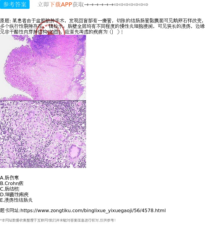 肠伤寒病理图图片