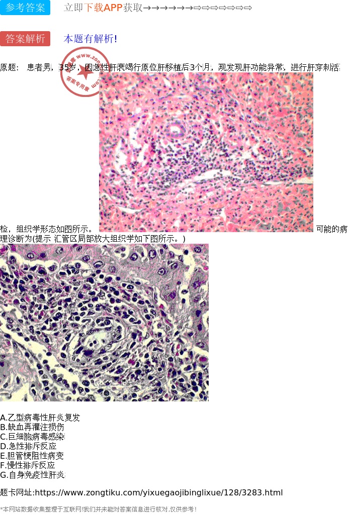 可能的病理诊断为(提示 汇管区局部放大组织学如下图所示