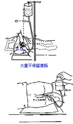 大量不保留灌肠与小量不保留灌肠的区别是)