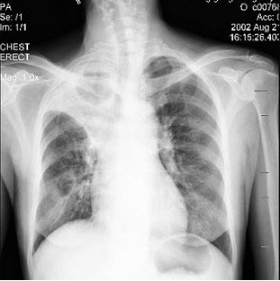 患者女性48岁咳嗽2个月胸片检查如图最合适的诊断为